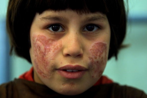 Girl With Facial Scars Caused By Cutaneous Leishmaniasis A Disfiguring And Disabling S